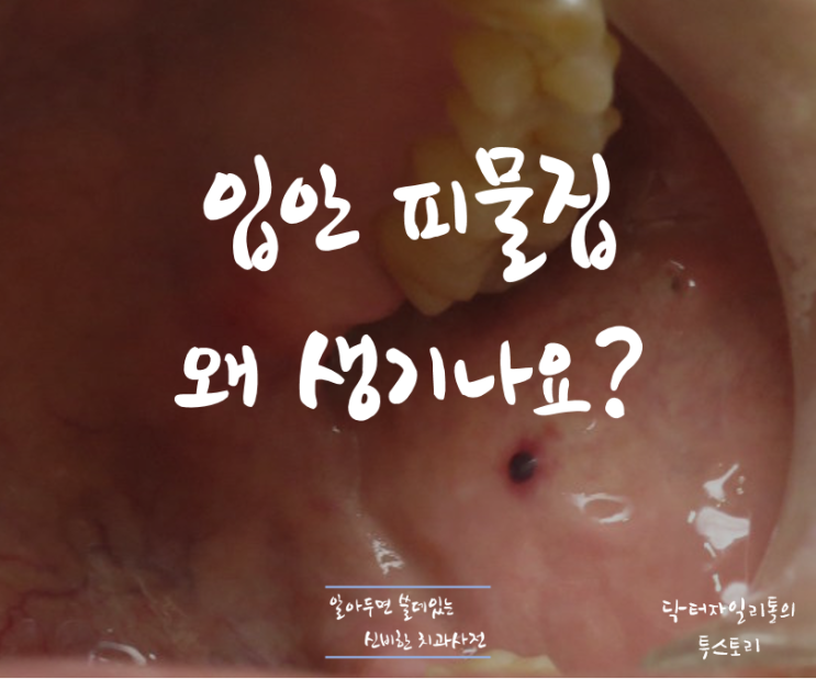 알쓸신치 :: 입안에 생기는 피물집 원인과 치료 :: 혈종 / 피멍울 : 네이버 블로그