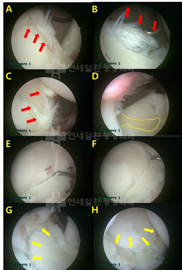 후방관절와순 파열 및 관절와순 주위 낭종에 대해 낭종 제거술 및 후방 관절 와순 봉합술의 결과
