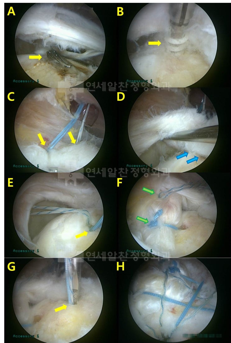 극상근, 극하근, 견갑하근 광범위 파열에 대한 일열 및 이열 봉합법을 이용한 하이브리드(Hybrid) 봉합술의 결과