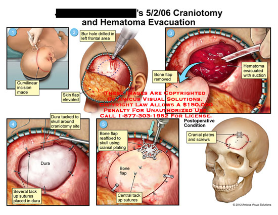 craniotomy-vs-craniectomy