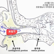 [보청기 피드백] 보청기 음향 되울림이 생기는 이유는 외이도 구조 때문