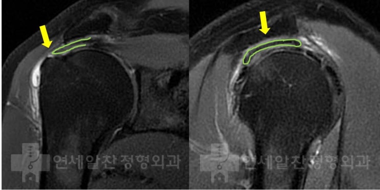 극상근 점액낭측 파열에서 이중 교량형 봉합술의 결과