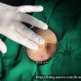 [Dr.ParK] 젊은 여성 유방에 만져지는 거대 결절(종괴).. 어떻게 치료해야 하나?