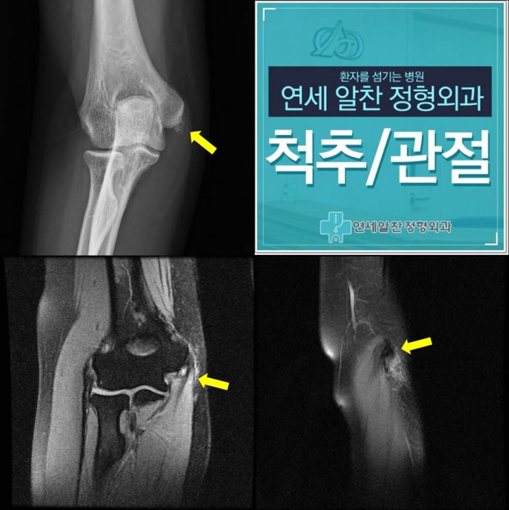 주관절 석회성 건염을 동반한 내측 총수지 굴곡건 파열에서 석회제거술 및 굴곡건 봉합술의 결과