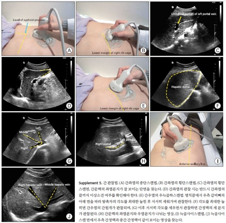 복부초음파 술기 및 소견 abdominal Sono / US [초음파 검사 방법] : 네이버 블로그