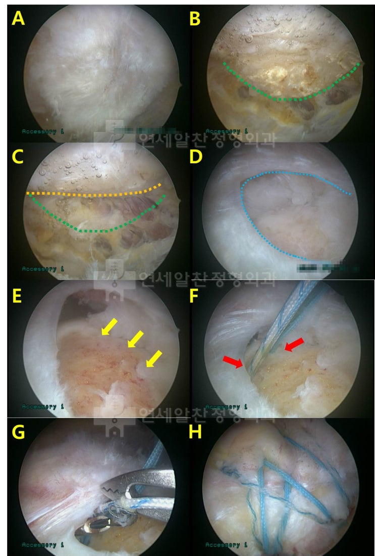 극상근 파열 및 충돌증후군에서 이열교량형 봉합술 및 견봉 성형술의 결과