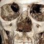 강남에서 3번 윤곽재수술을 하신 분의 광대재수술 CT분석