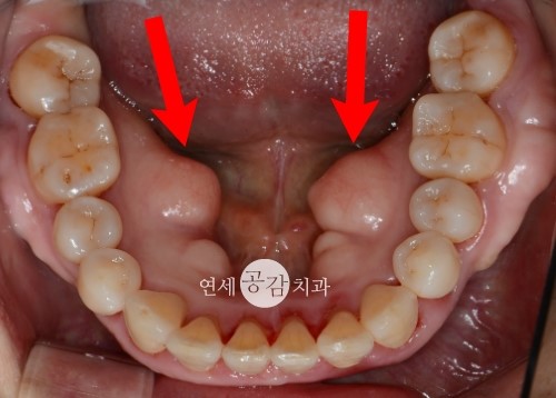 잇몸뼈 돌출 혹시 암 아닌가요? : 네이버 블로그