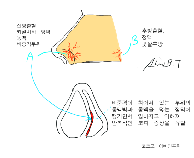 잦은 코피, 반복되는 코피의 원인, 비중격만곡증과 그 치료 : 네이버 블로그