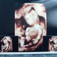 임신 3개월 12주차 임산부 : 1차 기형아 테스트와 입덧