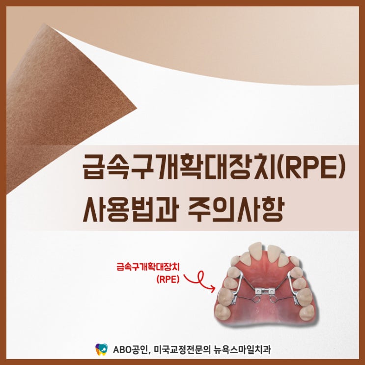[부산 비수술 주걱턱 교정치료] 급속구개확대장치(RPE) 사용법과 주의사항 :: 부산 비수술 반대교합 교정치료 - 해운대 뉴욕 ...
