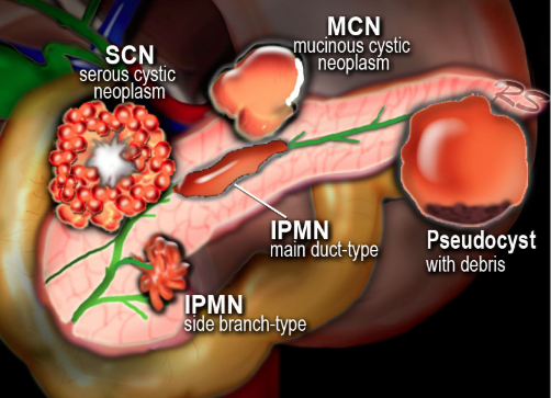 pancreatic-cystic-tumor