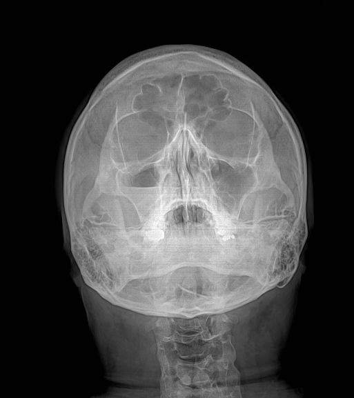 Rt. maxillary sinusitis : 네이버 블로그