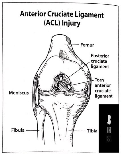 Anterior Cruciate Ligament (ACL) Injury (전방십자인대)의 발생,증상,진단,치료 : 네이버 블로그