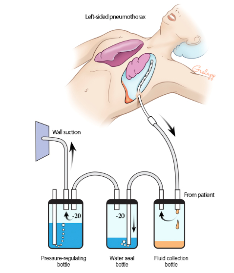 (TS 흉부외과) Atmos..? Chest tube..인가...?? : 네이버 블로그