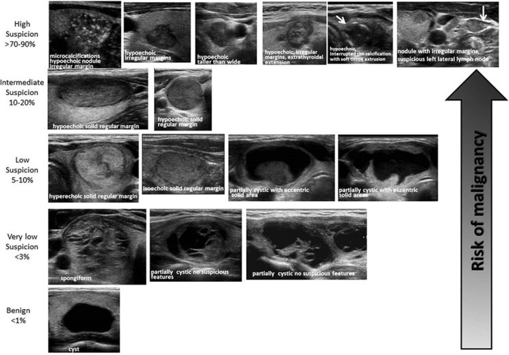 갑상선 초음파상 크기 1cm 미만 결절 중 세침흡인검사 FNA 대상 [Thyroid nodule / 대한갑상선학회 가이드라인