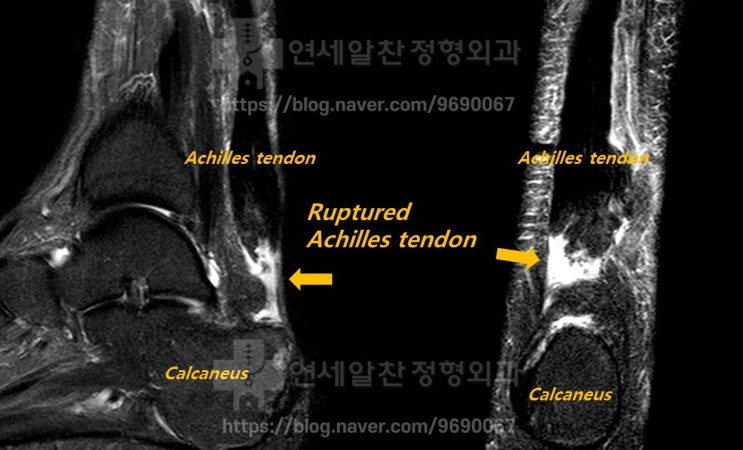 아킬레스건 기시부 파열에서의 수술적 방법에 대한 고찰 - SpeedBridge technique