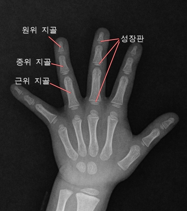 소아 외상, 소아 손가락 골절 각론 1편: 근위 지골 성장판 골절 : 네이버 블로그