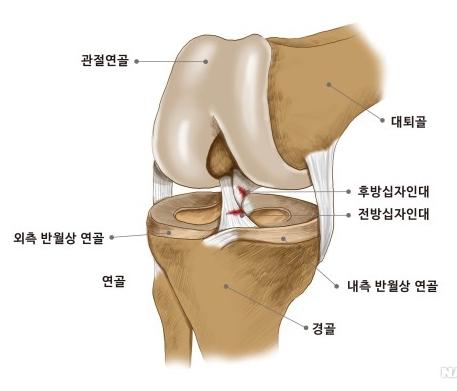 십자인대파열 네이버 블로그