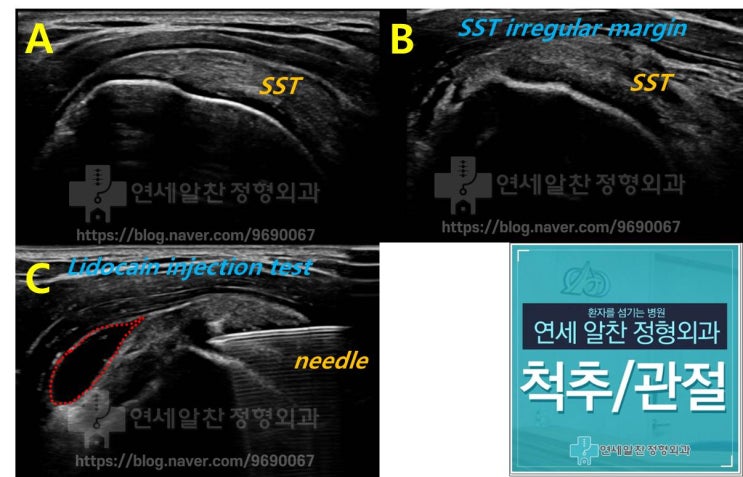 극상근파열 에서 초음파를 이용한 전층파열의 진단법