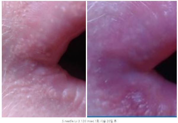 입술 좁쌀, 포다이스반의 아그네스 치료법 : 네이버 블로그