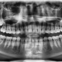 알아두면 요긴한 치과 파노라마 엑스레이 사진 보는 법