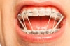    How Elastics Work With Braces Min 