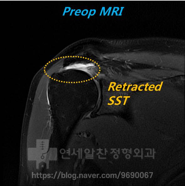 회전근개파열 (복원불가) 에서 이두장건 및 인조인대(메가덤) 을 이용한 재건술