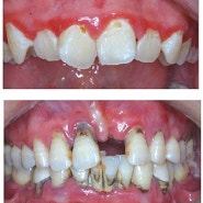 대구잘하는치과 '잇몸병 치주염 진단과 치료'