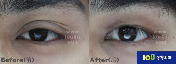 눈재수술(쌍꺼풀재수술):쌍꺼풀푸는수술,눈매교정,함몰눈 Removal of double fold,Ptosis ,sunken ...
