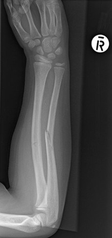 greenstick fracture x ray