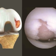 메디스포정형외과 - 무릎센터 - 연골클리닉