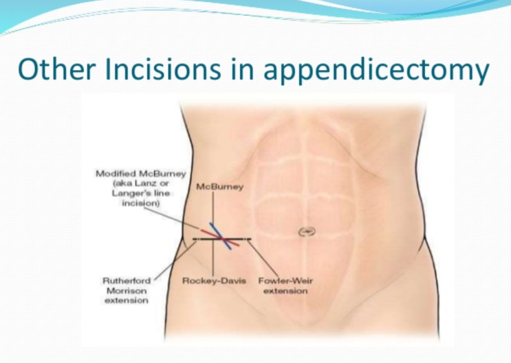 [의학전사] Appendectomy : 네이버 블로그
