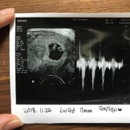 [임신7주/초기] 아기크기확인, 분만예정일확인, 심장소리를 처음 들었어요!