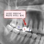 엑스레이로 아말감, 레진, 인레이, 크라운 등 충치치료 상태 보는 법