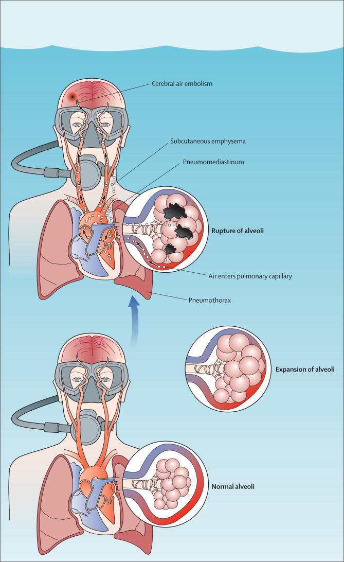 decompression-sickness