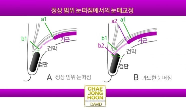 눈매교정 부작용: 과교정되었을 때, 그냥 풀어야 하나? (2) /눈매교정 풀기 : 네이버 블로그