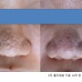 염증성 여드름 후에 코에 생긴 비후성 흉터 치료: 아주 심한 케이스 치료 과정(3)