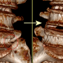 극외측협착증 (Extraforminal stenosis L5/S1, Far Out Syndrome) 의 수술전후 CT & MRI findings