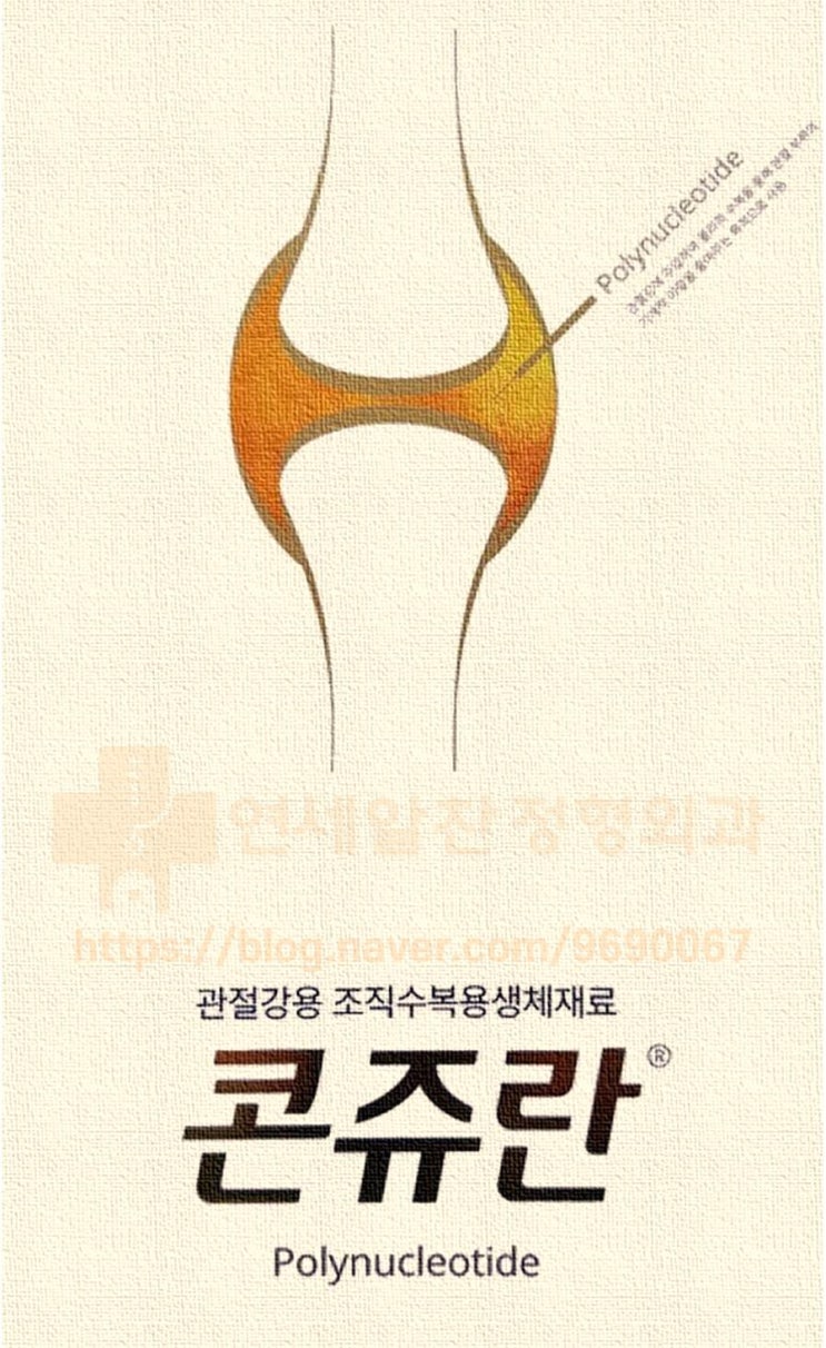 퇴행성관절염 치료하는 무릎연골주사, 안전할까?