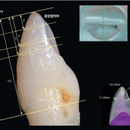 [치아의 기본 형태] 자연치 형태의 관찰_지대치 형성량_생생플란트치과