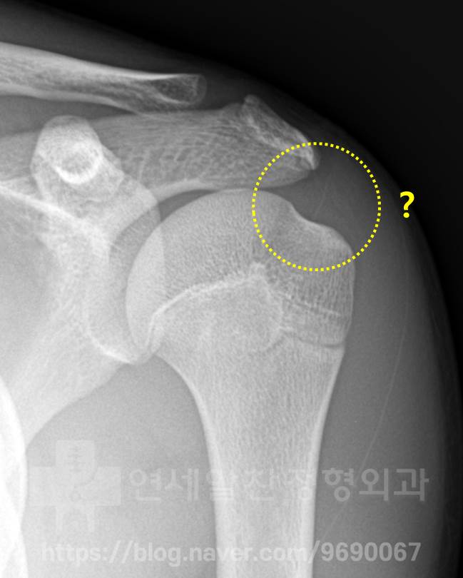 어깨 석회성건염 치료하려면 X-ray, 초음파, MRI 뭘 찍어야 할까?