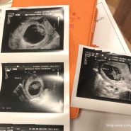 <임신일기> 쌍둥이 임신 3개월 증상 / 임신 8주차 9주차 10주차 11주차 증상 / 임신초기 증상