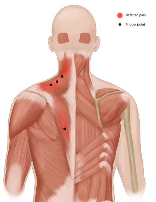 myofascial pain syndrome fibromyalgia 