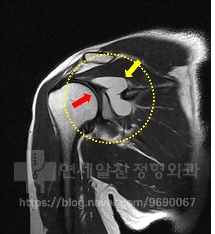 어깨관절와순 파열 없어도 물혹 제거 수술 해야할까?