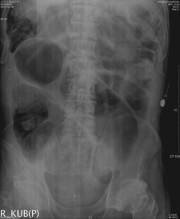 Stercoral colitis - 대변이 colon을 막으면 위험해! : 네이버 블로그