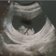 임신8주 증상과 태아 젤리곰 실체를 보았다 !