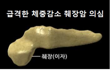 급격한 체중감소 그리고 황달 발생시 췌장암 의심 : 네이버 블로그