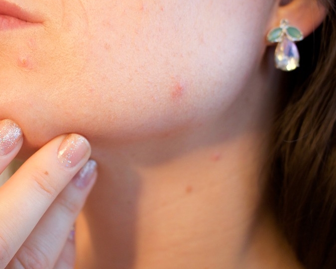 피부 오돌토돌 가려움 증상 원인과 해결방법! 얼굴이 가려울때 : 네이버 블로그