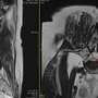 극외측 협착증 수술전후 3D CT 소견 두번째